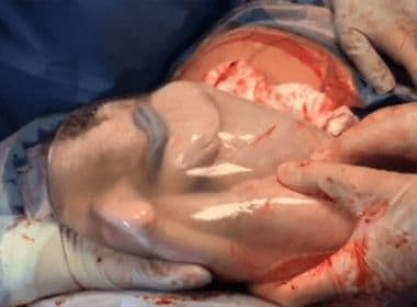 Gêmeos nascem ‘empelicados’ dentro da bolsa amniótica, médico compartilha e vídeo viraliza