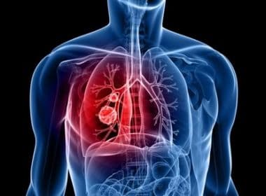Procedimento não invasivo, Radiocirurgia contra câncer de pulmão tem 89% de êxito