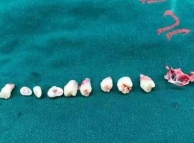 Médicos removem nove dentes do cérebro de criança