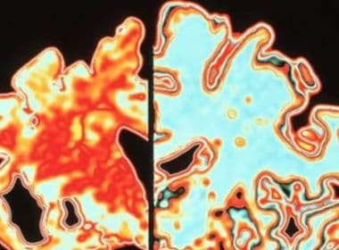 Estudo comprova que Alzheimer deve ser subdividido em seis grupos