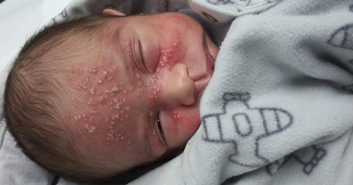 Após filho de 17 dias contrair herpes, mãe alerta sobre risco de se beijar bebês 
