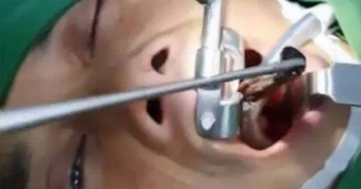 Cirurgião retira sanguessuga da garganta de mulher no Vietnã