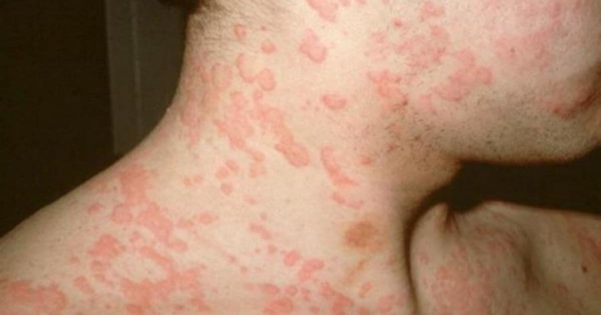 Especialista alerta sobre risco de menosprezar alergias e revela aumento de casos graves