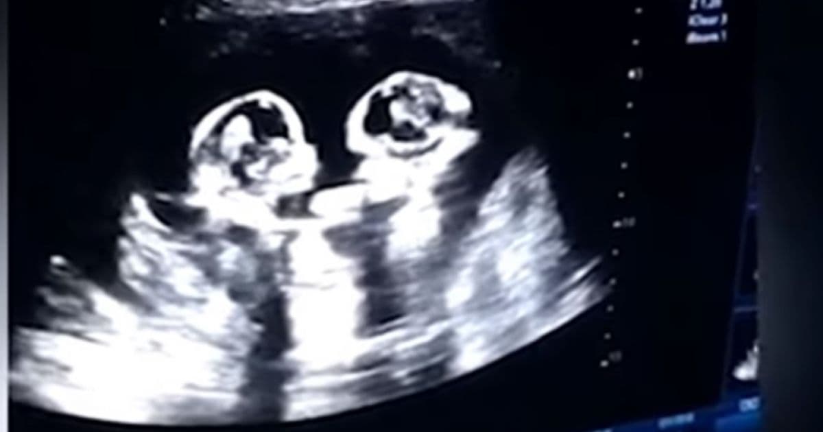 Ultrassom mostra gêmeas brigando dentro do útero da mãe; veja vídeo