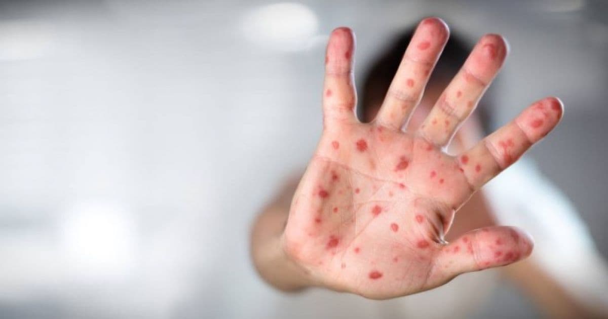 Organização Mundial da Saúde aponta aumento de 300% de casos de sarampo no mundo