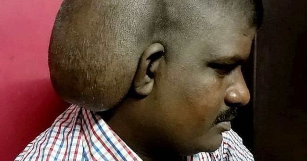 Médicos retiram maior tumor cerebral do mundo da cabeça de homem indiano