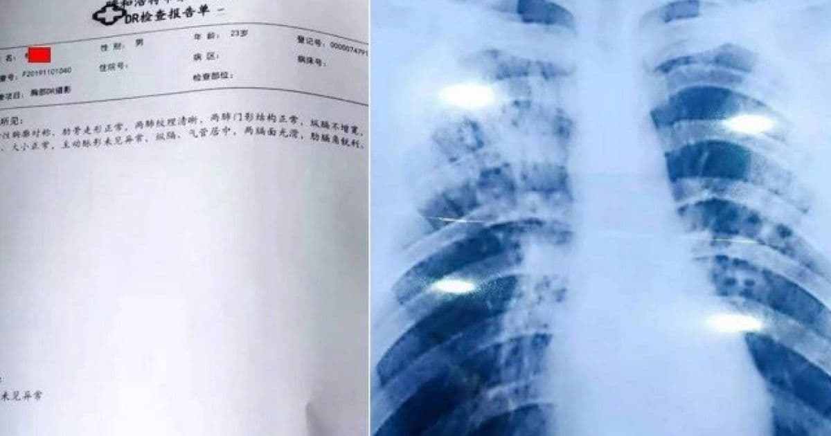 Professor da China compra diagnóstico de tuberculose por R$ 270 para prolongar feriado