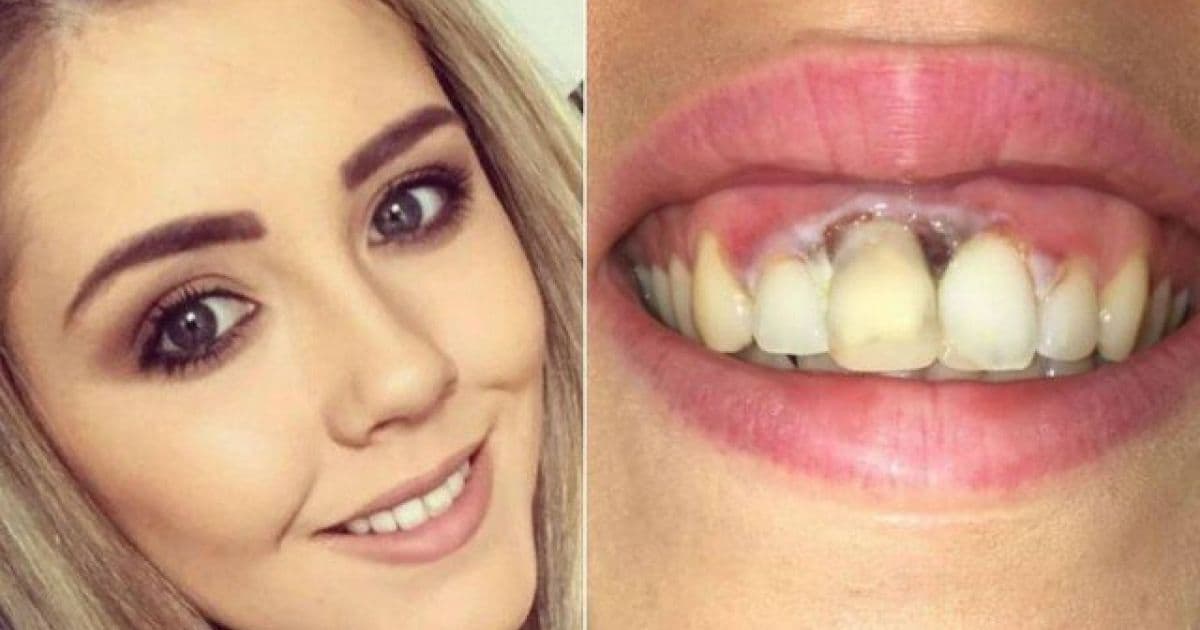 Irlandesa sofre queimadura na gengiva após procedimento de clareamento dos dentes