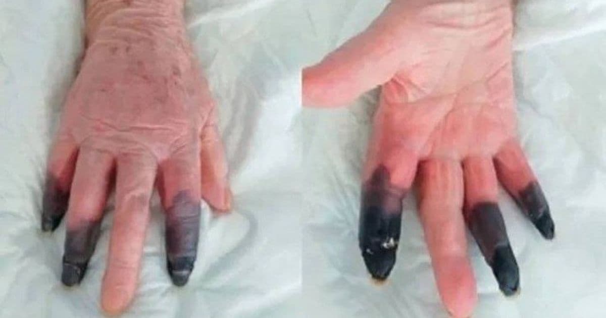 Em condição rara causada pela Covid-19, paciente tem dedos amputados na Itália