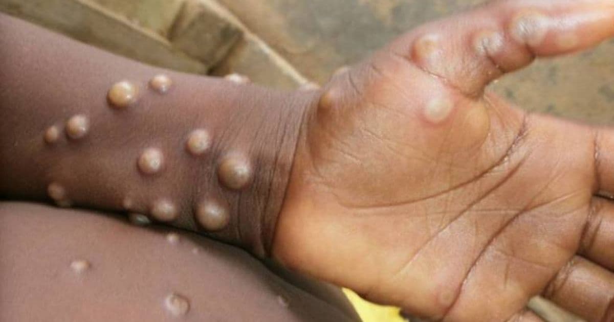 Sesab faz recomendações para evitar contágio da varíola dos macacos: 'Não há casos suspeitos'