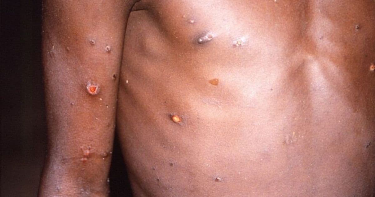 Bahia registra segundo caso de varíola dos macacos; infectado fez viagem internacional