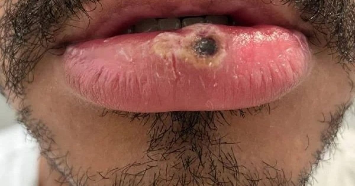 Com afta, jovem descobre monkeypox: 'Dor como cacos de vidro no lábio'