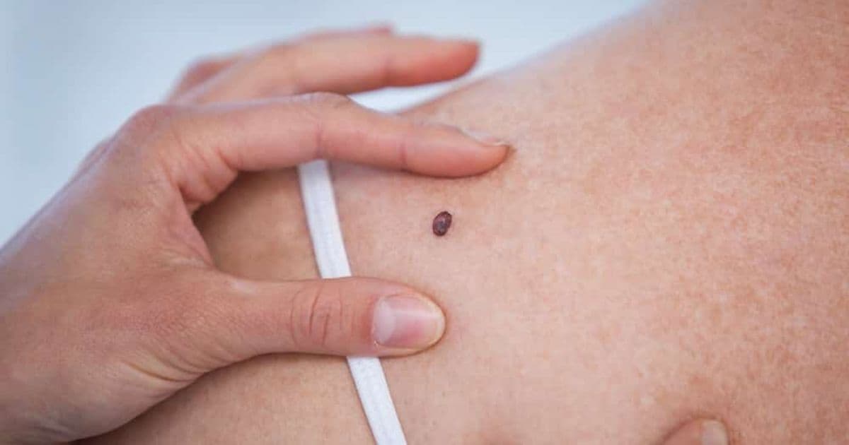 Vacina contra câncer de pele tem resultados positivos e vai entrar em fase final de estudo