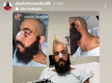 Internado, Danilo Fernandes exp&otilde;e marcas do atentado com bomba: 'At&eacute; quando?'