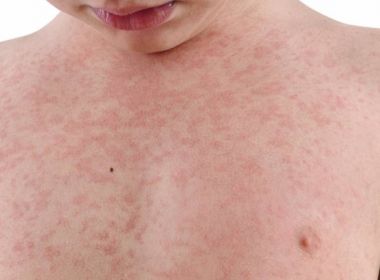 Secretaria brasileira faz alerta sobre sarampo na Copa da Rússia