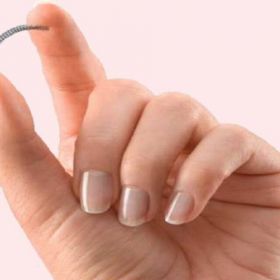 Mulheres com implante anticoncepcional da Bayer não conseguem retirá-lo pelo SUS