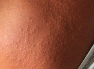 Pesquisadores veem elo entre surto de sarna e uso de ivermectina