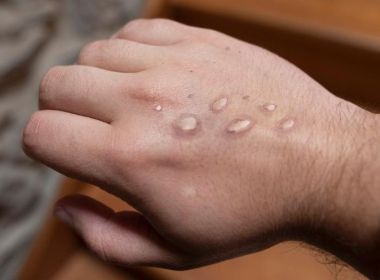 São Paulo confirma 2º caso de varíola dos macacos