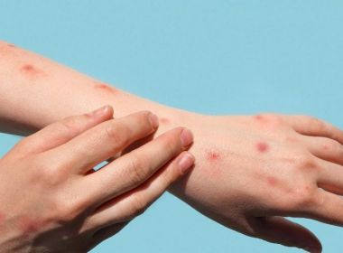 Brasil confirma 7º caso de varíola dos macacos, com paciente no RS