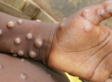 Butantan cria comitê para estudar produção de vacina contra varíola dos macacos