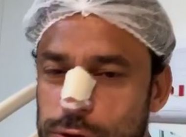 Fred passa por cirurgia após nariz quebrado em jogo e mantém zoeira na web