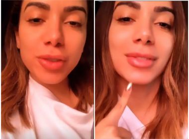 Anitta faz novo preenchimento para ficar com boca igual a filtro do Instagram: 'Está metida'