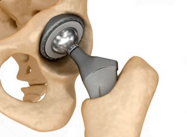 TJ-BA condena hospital a indenizar paciente por implante de prótese menor na perna