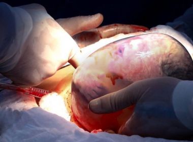 Fotógrafa registra caso raro de 3 irmãos que nasceram 'empelicados'; veja imagens