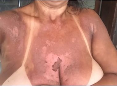 Itabuna: Mulheres denunciam clÃnica por queimaduras durante bronzeamento com fita