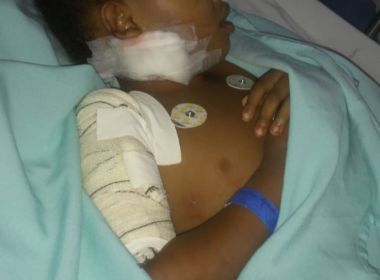 Ipiaú: Criança de 6 anos passa por 3 cirurgias após ser atacada por pit bull de vizinho