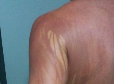 Ilhéus: Turista é internado após ficar com corpo manchado