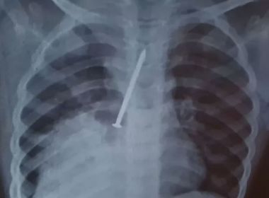 Canavieiras: Menino morre após passar 1 ano com prego no pulmão