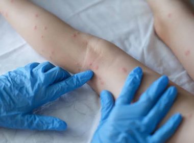 Bahia registra mais sete casos de 'varíola dos macacos' neste sábado