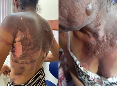 Ipiaú: Mulher sofre queimaduras após companheiro jogar água fervente nela