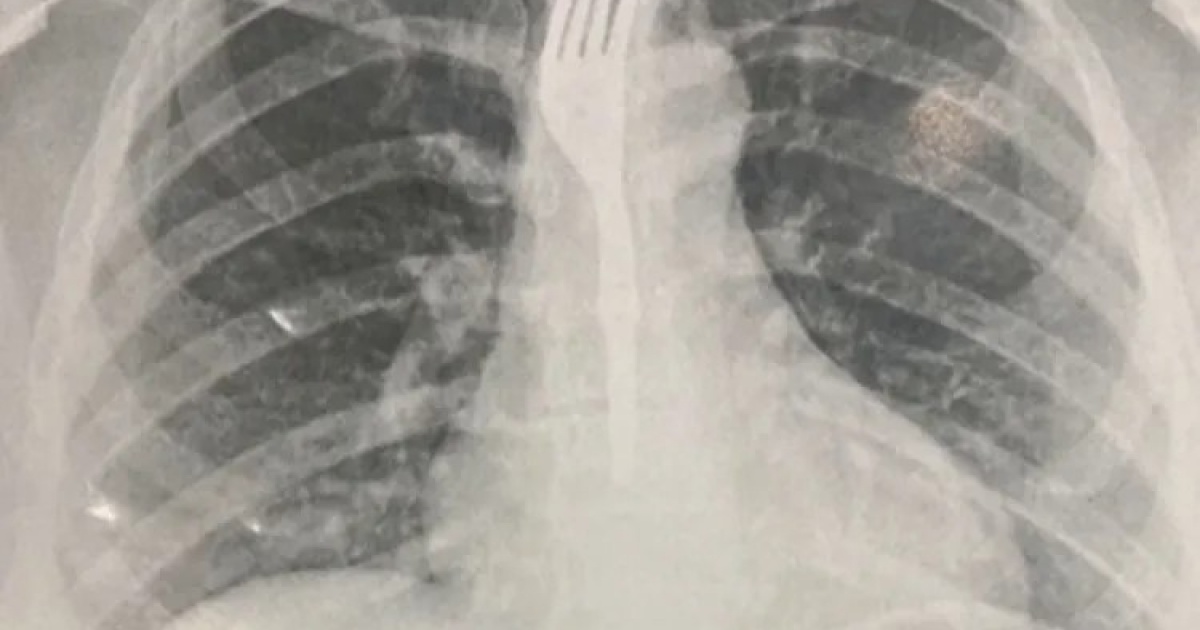 Com garfo no corpo, mulher é internada em hospital após engolir utensílio durante refeição na Bahia