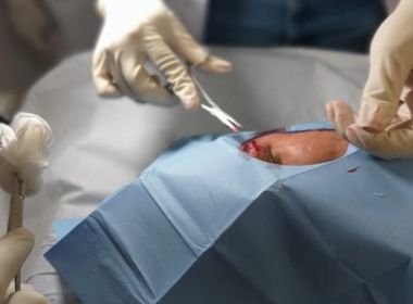 Carnaval 2020: 297 cirurgias de face e pescoço foram realizadas por conta de agressões