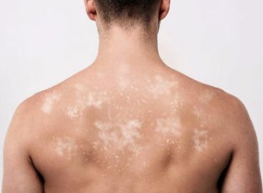 Chuva e praia são 'combinação perfeita' para micoses, alerta especialista