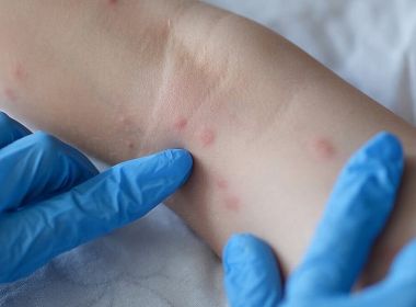 Após revisão, Secretaria de Saúde 'desconfirma' caso de Varíola do Macaco em Ilhéus