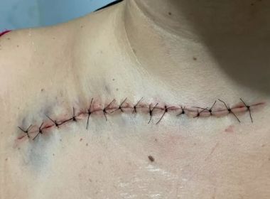 Mulher tem alta médica em Salvador após levar golpes de estilete aplicados por filho