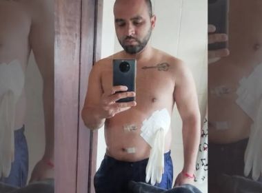 Médico usa luva cirúrgica no lugar de bolsa de colostomia em paciente: 'Medicina de guerra'