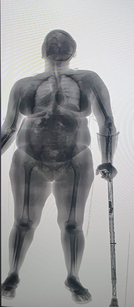 Idosa é flagrada tentando entrar com drogas e eletrônicos escondidos em muleta e chinelo na Cadeia Pública de Salvador 3 001.