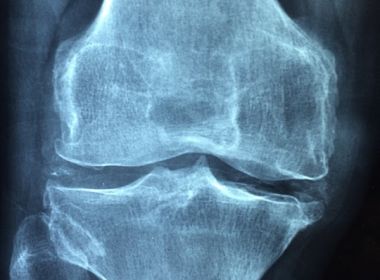 Viver Bem: DiagnÃ³stico precoce Ã© essencial no combate Ã  osteoporose