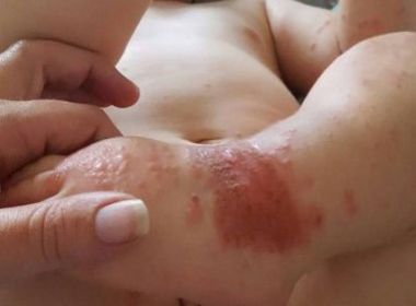 Bahia Noticias Saude Noticia Apos Ser Beijado Bebe De Um Ano Contrai Herpes E Mae Faz Alerta 22 09 16