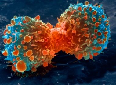 Cientistas desenvolvem medicamento para curar câncer de mama, cólon e pele