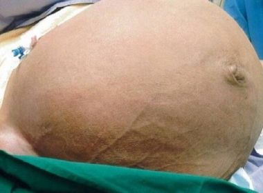 Médicos removem mioma uterino de 64 cm e quase 30 kg