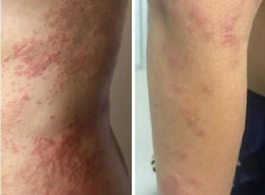Lesões e coceira: Salvador e RMS registram surto de dermatite com causa desconhecida