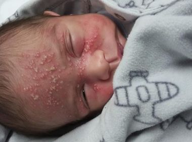 Após filho de 17 dias contrair herpes, mãe alerta sobre risco de se beijar bebês 