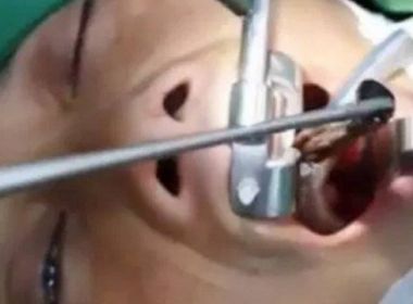 Cirurgião retira sanguessuga da garganta de mulher no Vietnã