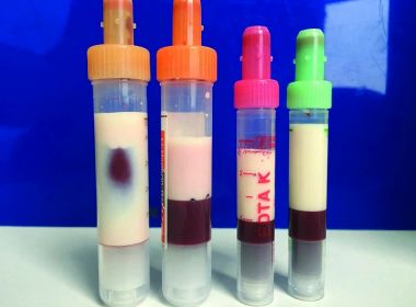 Alto nível de gordura provoca 'cor de leite' em sangue de paciente na Alemanha