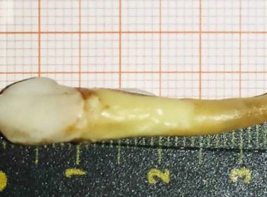 Maior dente da história é extraído por cirurgião-dentista alemão
